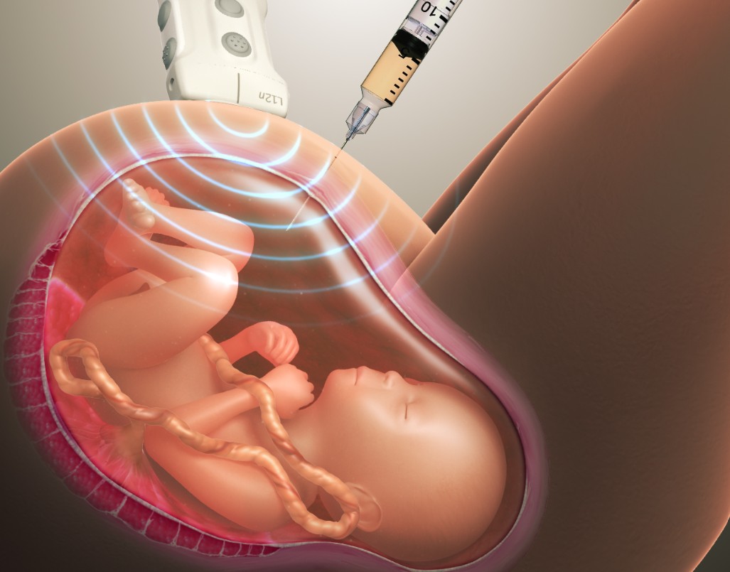 Understanding Amniocentesis - Myths & Facts - Dr Mamta Phogat